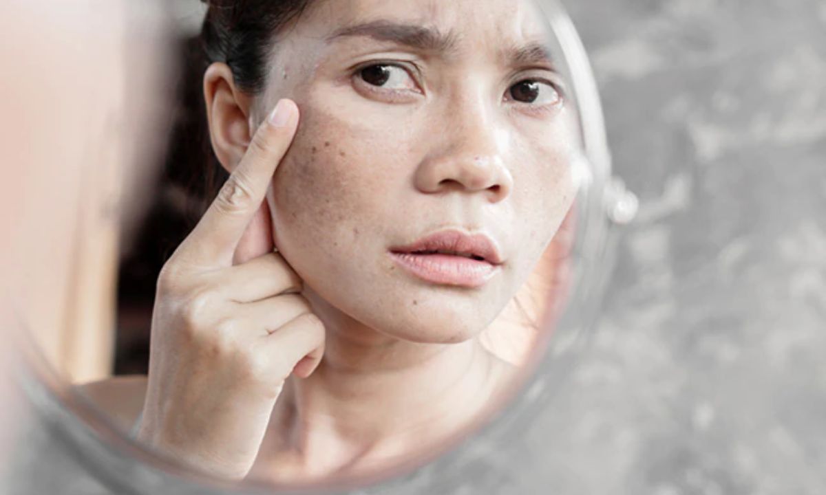 Face Blemishes Home Remedies